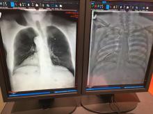 Carestream's new dual-energy X-ray imaging for its room install digital radiography (DR) system. Using software, the system can show a standard DR X-ray, a bone subtraction view and high and low Kv energy images, which bring out different sets of details in the image. The idea is to offer more diagnostic information from a single exam. The FDA cleared product allows low and high energy images to be created from a conventional DR X-ray using the vendor’s ImageView software.