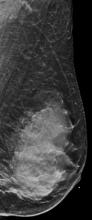 BI-RADS Category D: Extremely dense (most amount of fibroglandular tissue). Dense Breasts hide breast cancers.