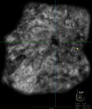 fibroglandular densities, dense breasts, breast cancer