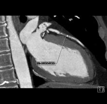 CTA, CCTA, CT angiography, ACC.15, ACC 2015, SCOT-HEART