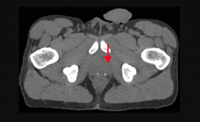 Axial fused PET/CT image shows intense uptake (arrowhead) in the deep pelvis corresponding to the left lobe of the prostate in a 62-year-old with a history of prostate cancer treated with radiation therapy.  The CT scan does not show the tumor. Image courtesy of the the Radiological Society of North America.