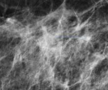 New York Breast Density Law Mammography Women's Health