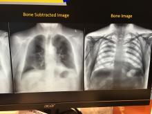 Here are a couple examples of dual energy digital radiography (DR) from a single X-ray image. These examples are from the start-up vendor KA Imaging. The company developed a DR detector plate that has three layers. The first layer produces a standard DR image. The second and third layers absorb low and higher energies to produce different versions of the image to better delineate soft tissue or bone. The Canadian company said it plans to submit this product for U.S. FDA in 2020.