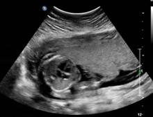 autism severity, diagnostic ultrasound, link, UW stud, genetics