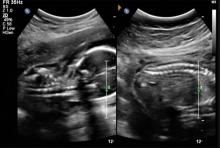 Fetal ultrasound picture composite created during exams to screen for spina bifida. Katherine Fornell. 