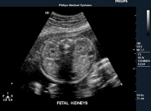Fetal kidneys on ultrasound. Imaged with a Philips Envisor system. This is a baby ultrasound, also referred to as fetal ultrasound, OB ultrasound or prenatal ultrasound.