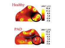 Hielscher, Columbia, PAD, OCT, diabetes, optical tomographic imaging, peripheral
