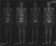 University of Manchester, PET, radiotherapy, cured patients, Hodgkin lymphoma