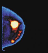 Molecular Imaging Broadens Scope in Breast Imaging