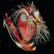 Siemens SOMATOM Sensation 64-slice system offers isotropic resolution of below 0.4 millimeter.
