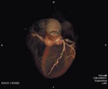Siemens SOMATOM Sensation 64-slice system offers isotropic resolution of below 0.4 millimeter.