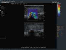 The suspicion that this ill-defined echopoor mass was malignant was supported by very high kPa values (over 200) in its periphery. The histology was a ductal carcinoma.