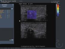 Any lesion that is echopoor and shows shadowing must be considered suspicious and this was graded as BI-RADS 4. The shear wave elastogram showed low values and the biopsy onlyshowedfibrous tissue.