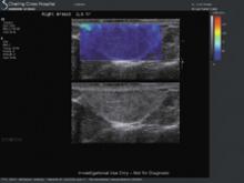 This echogenic lesion has low kPa values, similar to the surrounding breast tissue. Biopsy revealed fatty tissue and the final diagnosis was a lipoma.