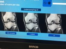 Philips Healthcare is using artificial intelligence (AI) to better reconstruct MRI images to remove artifacts and improve image quality. This example was shown by the vendor during a booth tour at RSNA 2019,Philips Healthcare is using artificial intelligence (AI) to better reconstruct MRI images to remove artifacts and improve image quality. This example was shown by the vendor during a booth tour at RSNA 2019,