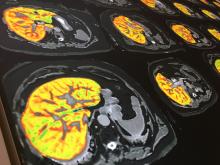 Artificial intelligence Liver Multiscan assessment software from Perspectum Diagnostics at RSNA 2019. The software uses automated MRCP computational assessments of bile duct diameters, enabling a fast quantification of the pancreatobiliary system. 