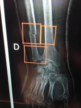 Artificial intelligence (AI) from Intrasense designed to detect bone fractures and highlight areas of interest for the radiologist as a first pass. The AI can assist as a second set of eyes to locate what might be hairline fractures, which can be difficult to see.