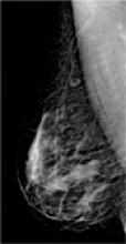 Right mediolateral oblique (RMLO)