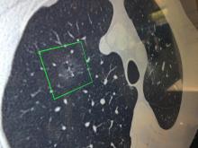 Infervision's artificial intelligence AI lung detection app. showing detection of a ground glass cancer lesion. 