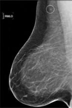 fibroglandular density, dense breasts, dense breast tissue