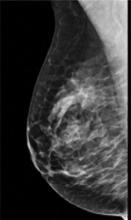 fibroglandular density, dense breasts, dense breast tissue