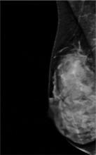 fibroglandular density, dense breasts, dense breast tissue