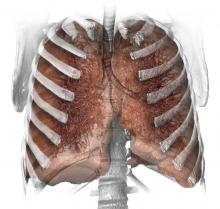 smoking, lung cancer, CT screening, guidelines