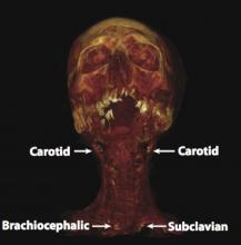 Mummy CT scans showing 3-D rendering showing a mummy with calcification in the carotid arteries.