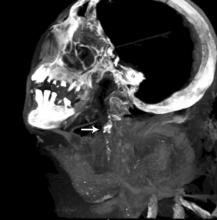 Mummy CT scans, showing Mummy with calcification in the carotid arteries.