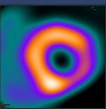 Nuclear cardiology, nuclear imaging, radiotracer production, automated radiosynthesis module, myocardial perfusion imaging