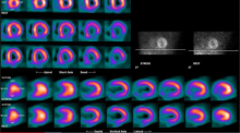 A Tc99m SPECT cardiac exam showing myocardial perfusion in the heart.