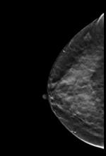 fibroglandular densities, dense breasts,