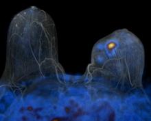 A Philips PET/MRI scan showing a breast cancer lesion from a study by the University of Geneva.
