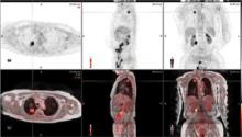 patient with lung cancer, MR/PET