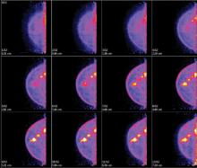 Example of molecular breast imaging (MBI) with breast cancer.