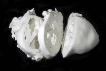 3-D heart model, congenital heart defects, cardiovascular surgery