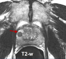 Prostate Cancer Hypofractionated Radiation Therapy Report Quality of Life