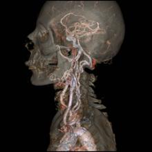 Low dose imaging is performed on the Somatom Force