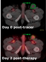 Radiation Test Run Predicts Outcome of Lymphoma Treatment