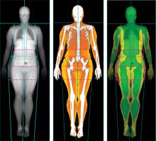 Body scans, Lunar iDXA