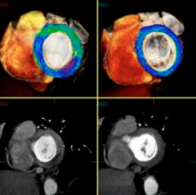 CT myocardial perfusion