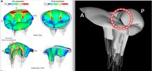 Images, or a digital twin mitral valve of a patient, created from cardiac ultrasound that were used to perform a virtual surgical procedure to test how the intervention would impact the patient prior to actually performing the procedure. The right image shows color coding for sheer stresses on the valve leaflets before and after the virtual surgery. The left image shows the model quantitation of leaflet coaptation at peak systole prior to the the virtual surgery.