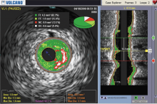 Volcano, Philips, acquisition, FFR, IVUS