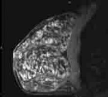 Breast MRI images can help identify tumors in dense breast tissue that might be obscured on traditional mammography.