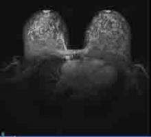 Breast MRI can be used to screen for cancers in women with dense breast tissue.