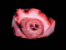 Csound, GE ultrasound, cSound, Mitral valve, cardiac ultrasound, cardiac echo, echocardiography, echo advances, ASE.16, ASE 2016, advances in cardiovascular ultrasound