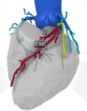 The Latest Advances in Coronary CT Angiography Software