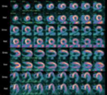 PET vs. SPECT, nuclear imaging advances Flurpiridaz F18