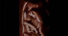 Fetus with hand in front of its face and umbilical cord seen using 3-D ultrasound. Images using Philips TrueVue imaging technology. This is a baby ultrasound, also referred to as fetal ultrasound, OB ultrasound or prenatal ultrasound.