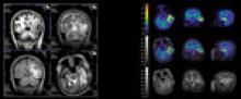 PET/MRI: The Modality of Choice? 